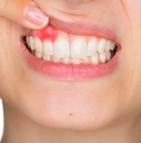 5 Preventive Dentistry Practices That Protect Against Gum Disease