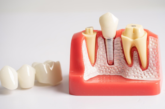 5 Signs You Should Ask Your Dentist About Implants