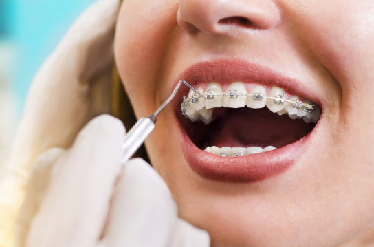 5 Common Myths About Orthodontics Debunked By General Dentists
