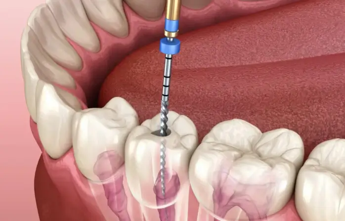 How Root Canal Therapy Restores Function And Comfort